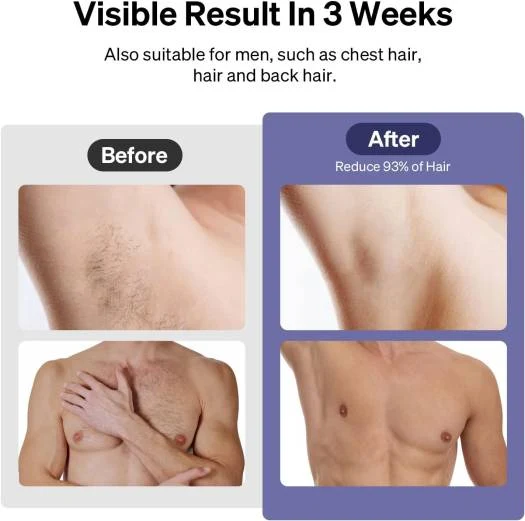Ulike Air 3 IPL Laser Hair Removal, For Women and Men, With Sapphire Ice-Cooling System, Painless & Long-Lasting Result, Flat Head Window for Body& Face Usage, Visible Result in 3 Weeks